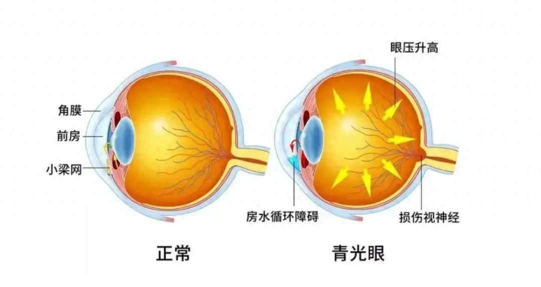 合肥爱尔青光眼专家教您：一文读懂青光眼激光治疗  